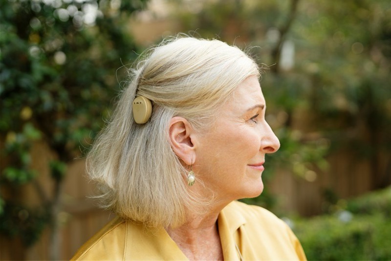 A slightly older woman with cochlear implants for single-sided deafness